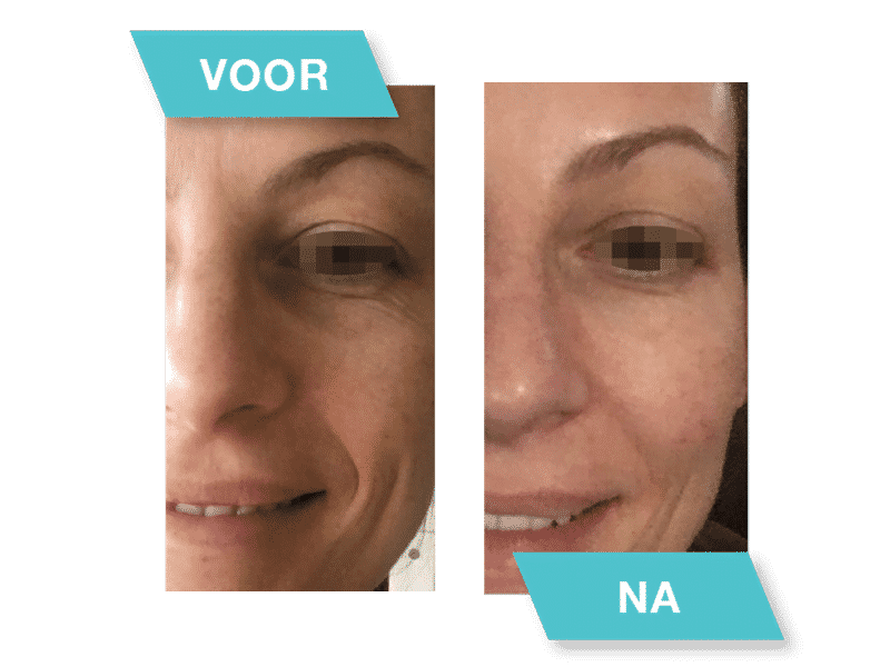 mpen voor na mesoestetic aestheticsolutions | es-clinic.be, Health & Skin care